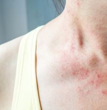 Eczéma